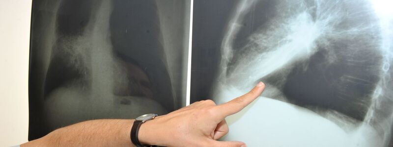 Ein Arzt zeigt auf ein Röntgenbild einer von Krebs befallenen Lunge (Illustration) - Foto: Felix Hörhager/dpa