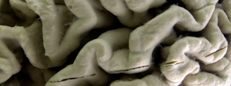 Das Gehirn eines Alzheimer-Patienten zeigt tiefe Furchen. (Illustration) - Foto: David Duprey/AP/dpa