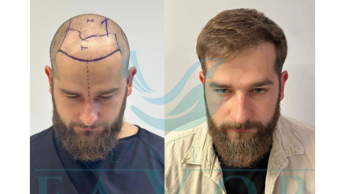 Top 10 Beste Haartransplantation Türkei 2026 - Testsieger & Klinik-Vergleich