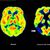 Haben die Amyloid-Plaques schon irreversible Schäden im Gehirn angerichtet, nützt ihre Entfernung nichts mehr. (Archivbild) - Foto: picture alliance / dpa